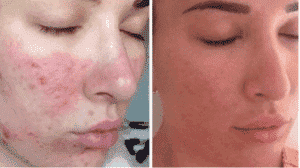 جلسات النضارة بالليزر المنزلي