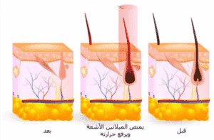 فوائد الليزر المنزلي